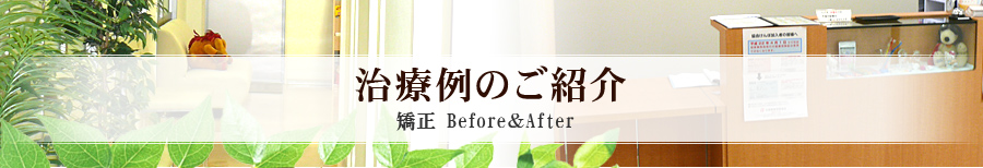 治療例のご紹介 矯正 Before&After